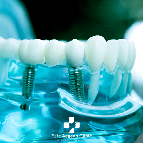 The All On 6 Dental Implants Turkey Procedure