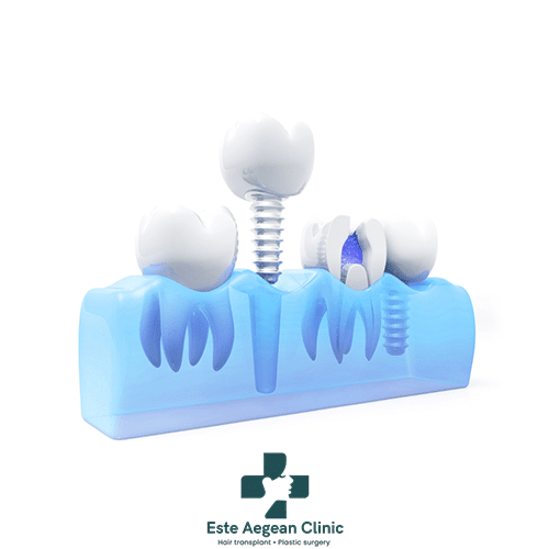 All On 6 Dental Implants Turkey vs. Other Countries