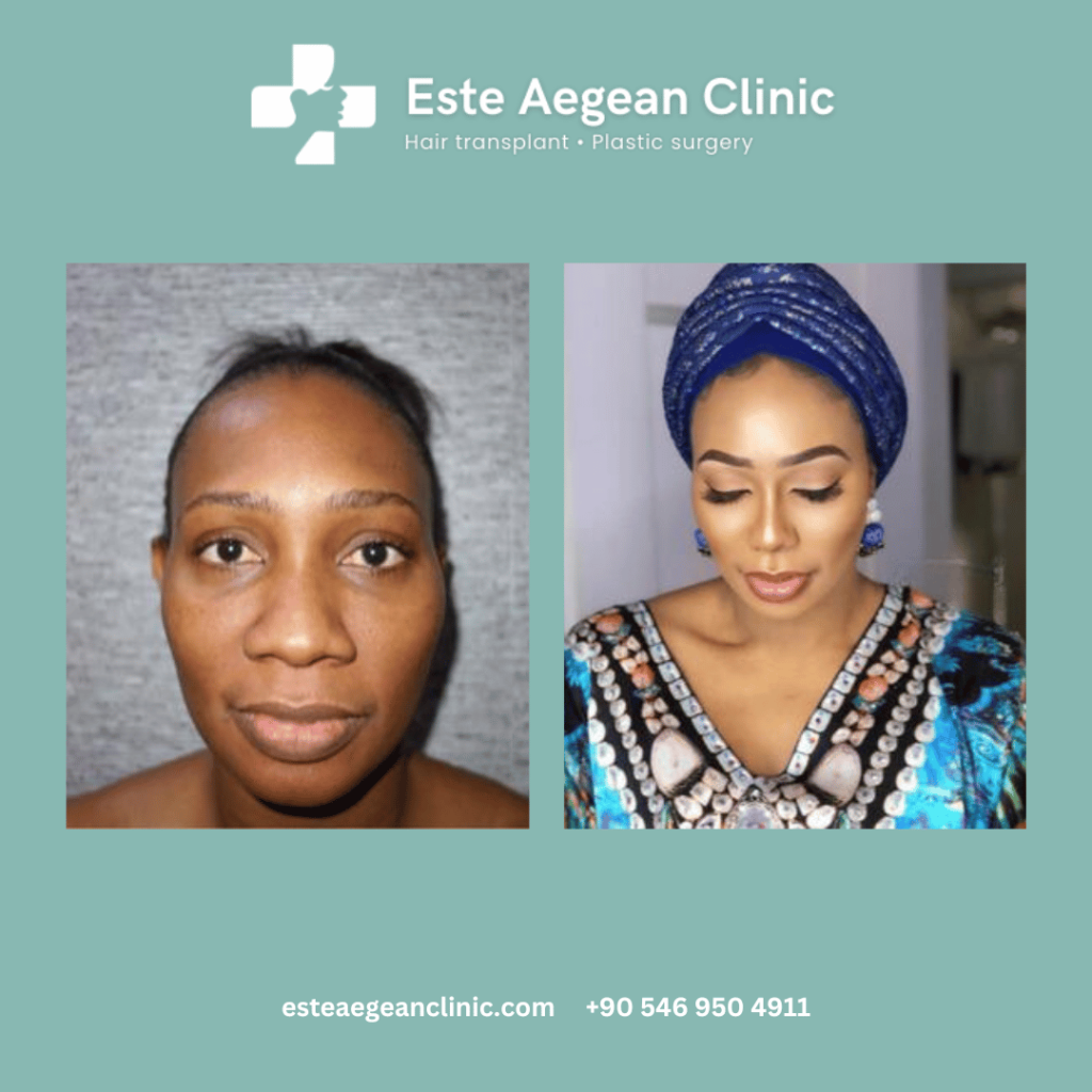 Ethnic Rhinoplasty Before and After