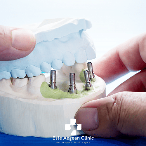 All on 4 Dental Implants in Turkey