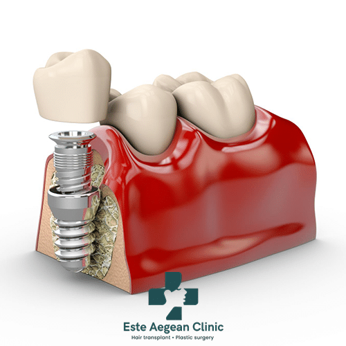 Advantages of All on 4 Dental Implants in Turkey