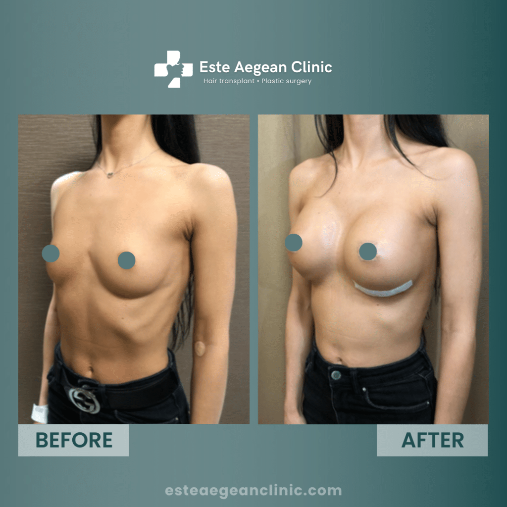 breast augmentation before and after 2