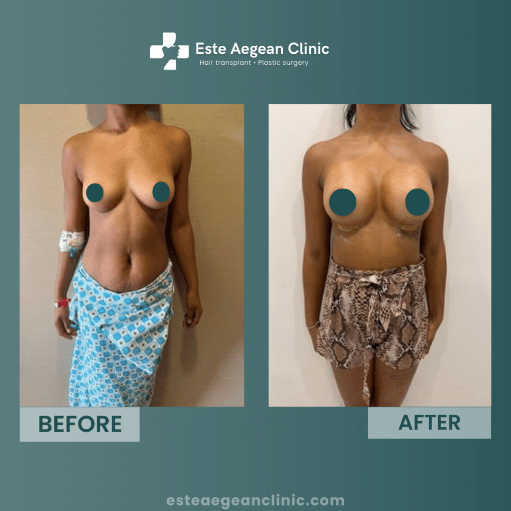 breast augmentation before and after 3