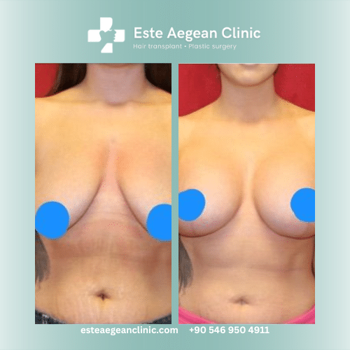 breast lift before after 1