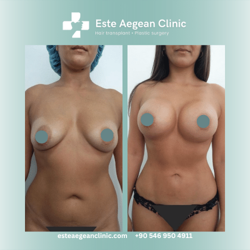 breast lift before after 2