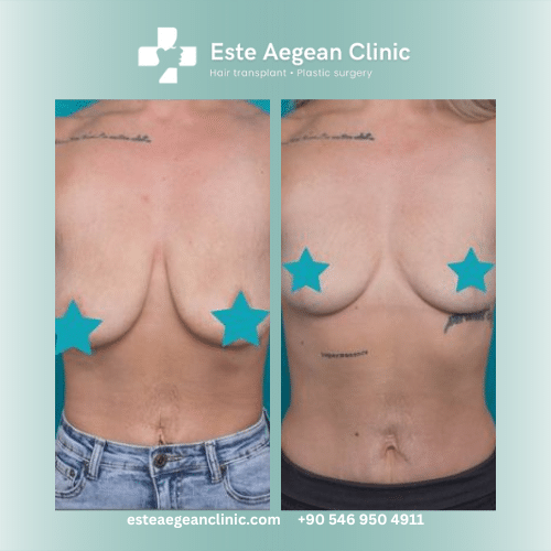 breast lift before after 3