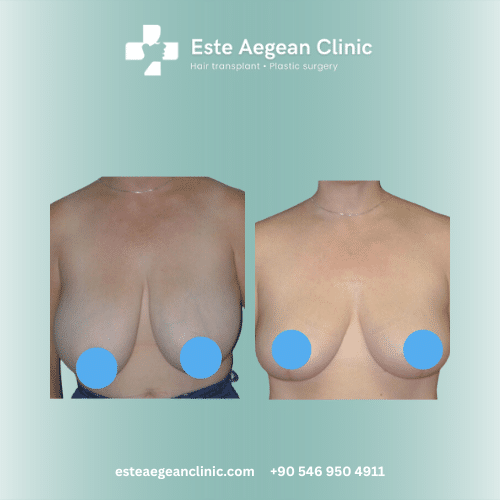 breast reduction before and after 1