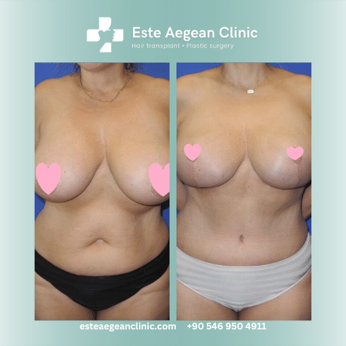 breast reduction before and after 3