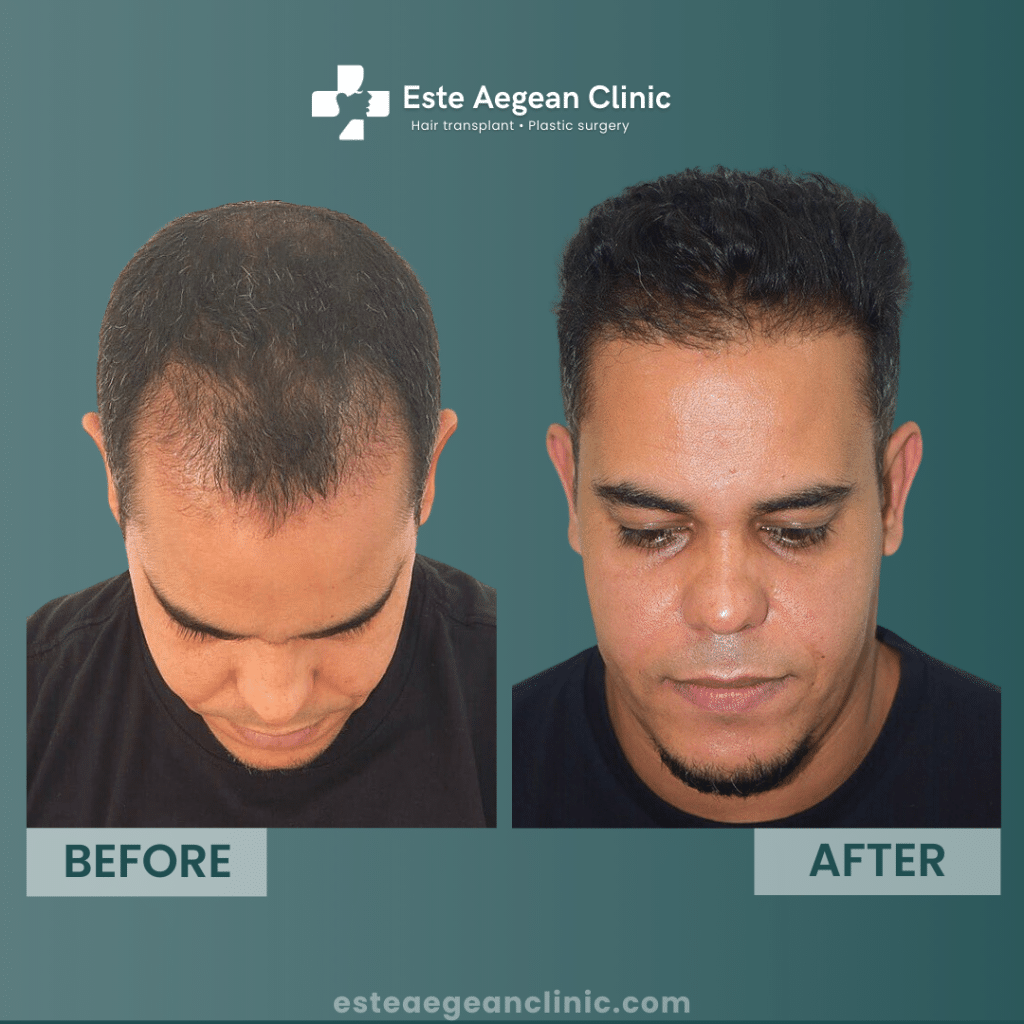 dhi hair transplant before after