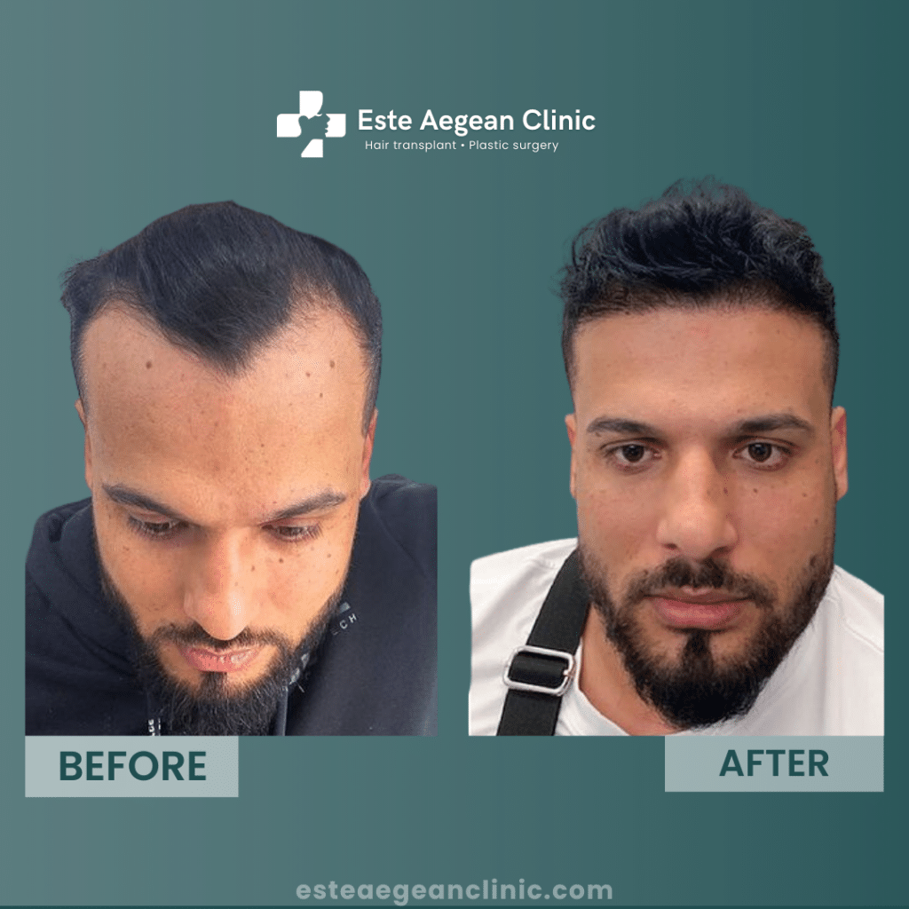 dhi hair transplant before after