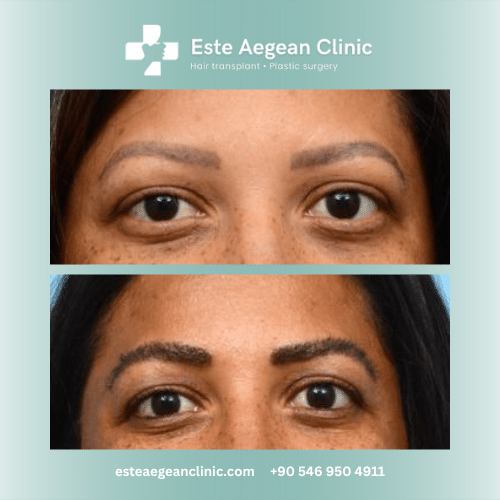 eyebrow transplant before and after