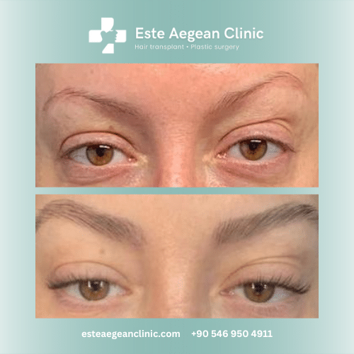 eyebrow transplant before and after