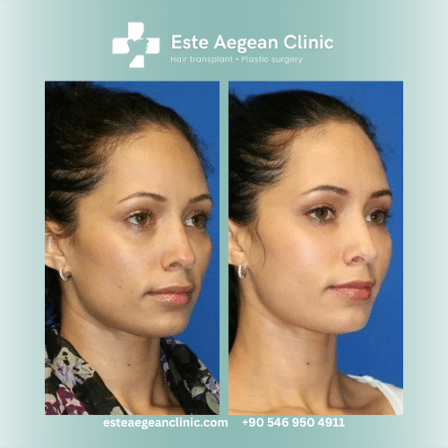fat injections face before and after
