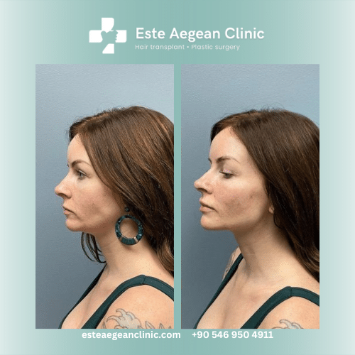 fat injections face before and after