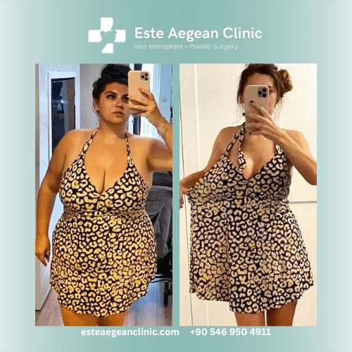 gastric sleeve before and after
