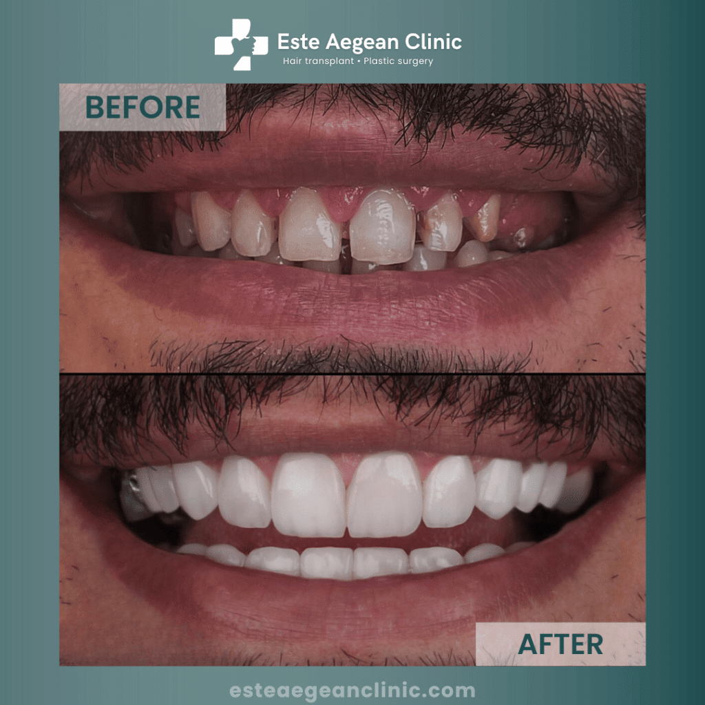zirconia crowns before and after