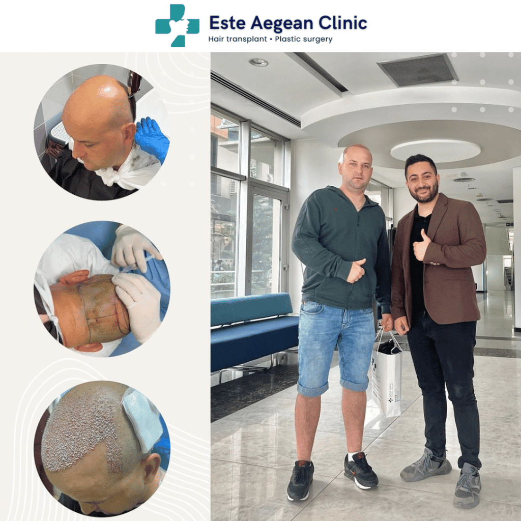 Chirurgia de transplant de păr în Turcia